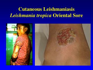 Cutaneous Leishmaniasis Leishmania tropica Oriental Sore