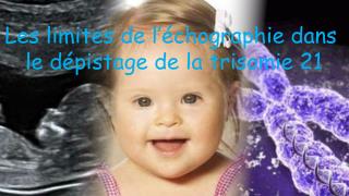 Ppt Les Limites De L Echographie Dans Le Depistage De La Trisomie 21 Powerpoint Presentation Id