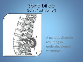 PPT - Spina Bifida PowerPoint Presentation - ID:1092120