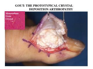 GOUT: THE PROTOTYPICAL CRYSTAL DEPOSITION ARTHROPATHY