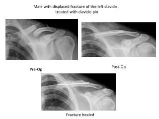 Male with displaced fracture of the left clavicle, treated with clavicle pin