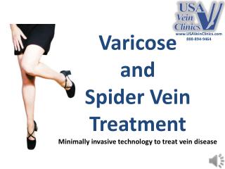 Varicose and Spider Vein EVLT Treatment - USA Vein Clinics