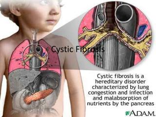 PPT - Cystic Fibrosis PowerPoint Presentation, free download - ID:2798642