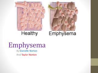 Emphysema