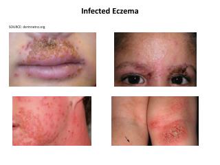 Infected Eczema