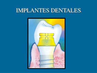 IMPLANTES DENTALES