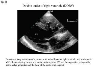 Double outlet of right ventricle (DORV)