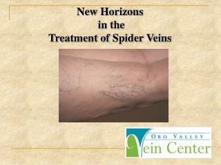 New Horizons in the Treatment of Spider Veins