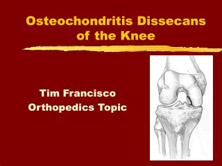 PPT - Osteochondritis Dissecans of the Knee PowerPoint Presentation ...