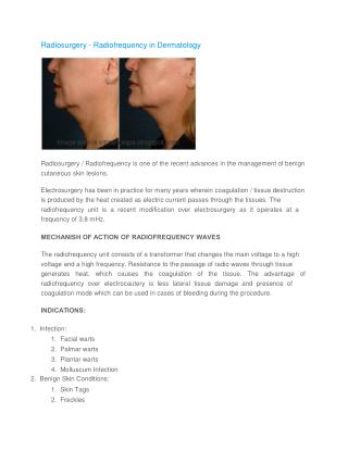 Radiosurgery - Radiofrequency in Dermatology