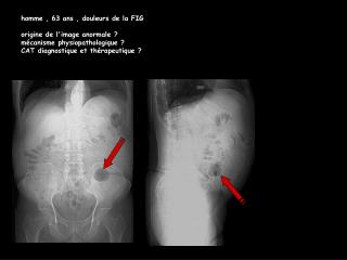 homme , 63 ans , douleurs de la FIG origine de l'image anormale ? mécanisme physiopathologique ? CAT diagnostique et th