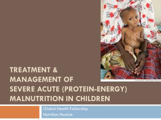 discuss the problem solving approach in management of protein energy malnutrition