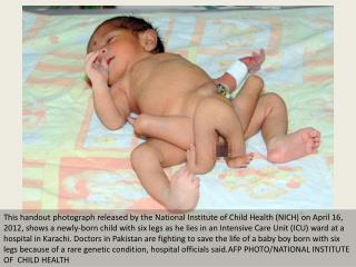 Doctors fight to save life of six-legged baby