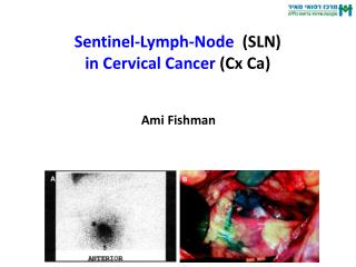Sentinel-Lymph-Node (SLN) in Cervical Cancer (Cx Ca)