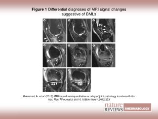 Figure 1 Differential diagnoses of MRI signal changes suggestive of BMLs