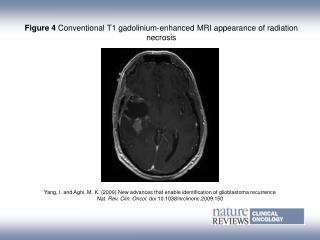Figure 4 Conventional T1 gadolinium‑enhanced MRI appearance of radiation necrosis