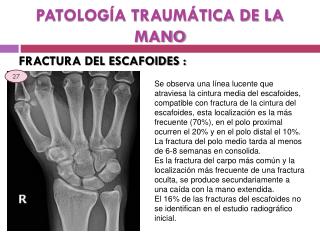 PATOLOGÍA TRAUMÁTICA DE LA MANO