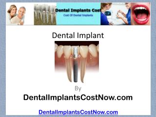 Dental Implant