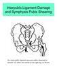 Interpubic Ligament Damage and Symphysis Pubis Shearing