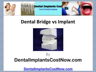Dental Bridge vs Implant