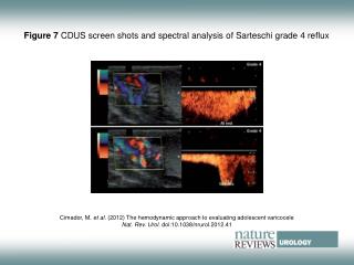 Figure 7 CDUS screen shots and spectral analysis of Sarteschi grade 4 reflux