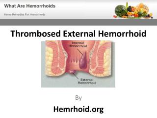 Thrombosed External Hemorrhoid Treatment