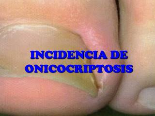 INCIDENCIA DE ONICOCRIPTOSIS