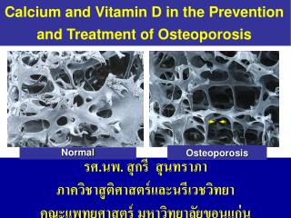 Calcium and Vitamin D in the Prevention and Treatment of Osteoporosis