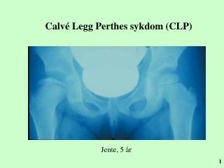 Calvé Legg Perthes sykdom (CLP)