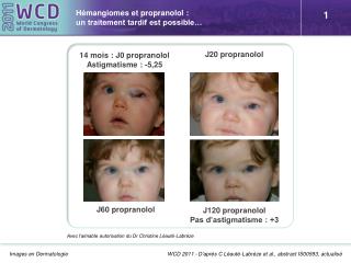 Hémangiomes et propranolol : un traitement tardif est possible…