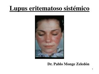 Lupus eritematoso sist émico