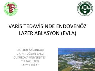 VARİS TEDAVİSİNDE ENDOVENÖZ LAZER ABLASYON (EVLA)