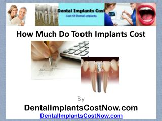 How Much Do Tooth Implants Cost