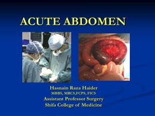 ACUTE ABDOMEN