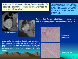 En el polo inferior del riñón derecho se ob-serva una masa sólida heterogénea de 5 cm