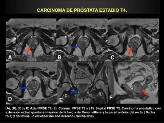 CARCINOMA DE PRÓSTATA ESTADIO T4.