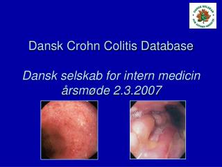 Dansk Crohn Colitis Database Dansk selskab for intern medicin årsmøde 2.3.2007