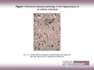 Figure 1 Alzheimer disease pathology in the hippocampus of an elderly individual