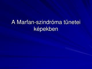 A Marfan-szindróma tünetei képekben