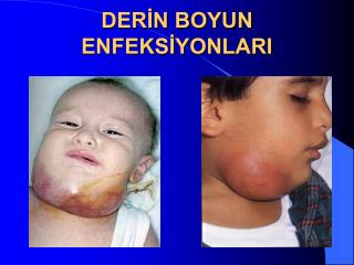 DERİN BOYUN ENFEKSİYONLARI