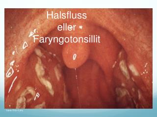 Halsfluss eller Faryngotonsillit