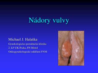 Nádory vulvy