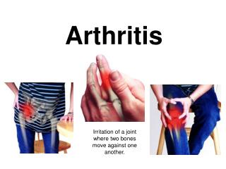 Arthritis