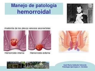 Manejo de patología hemorroidal