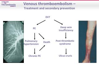 Venous thromboembolism – Treatment and secondary prevention