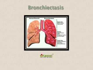 Bronchiectasis