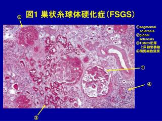 図 1 巣状糸球体硬化症（ FSGS ）