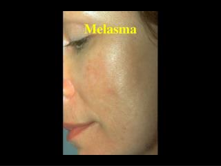 Melasma