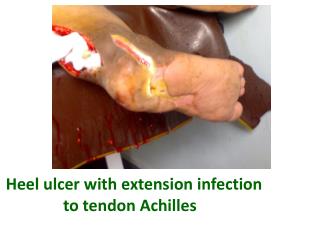 Heel ulcer with extension infection to tendon Achilles