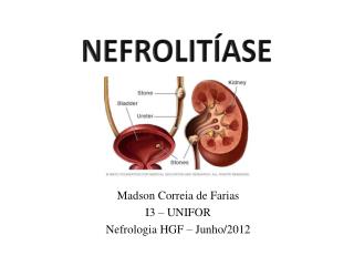 NEFROLITÍASE